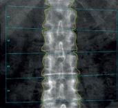 DXA spine